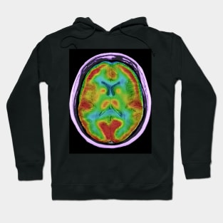 Normal brain blood flow, MRI and SPECT (C026/8000) Hoodie